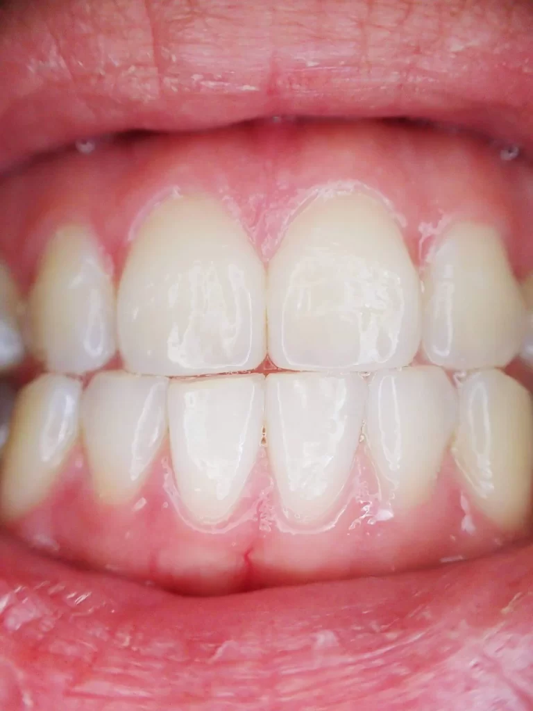 periodontal disease