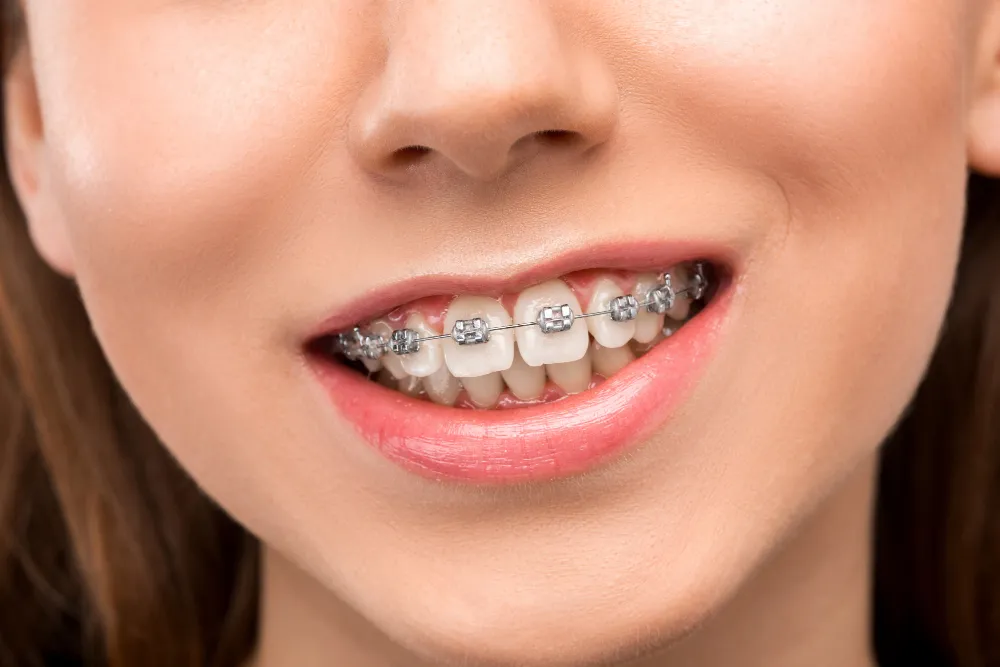 Women smiling with braces on - How Much Do Braces Hurt On A Scale 1-10