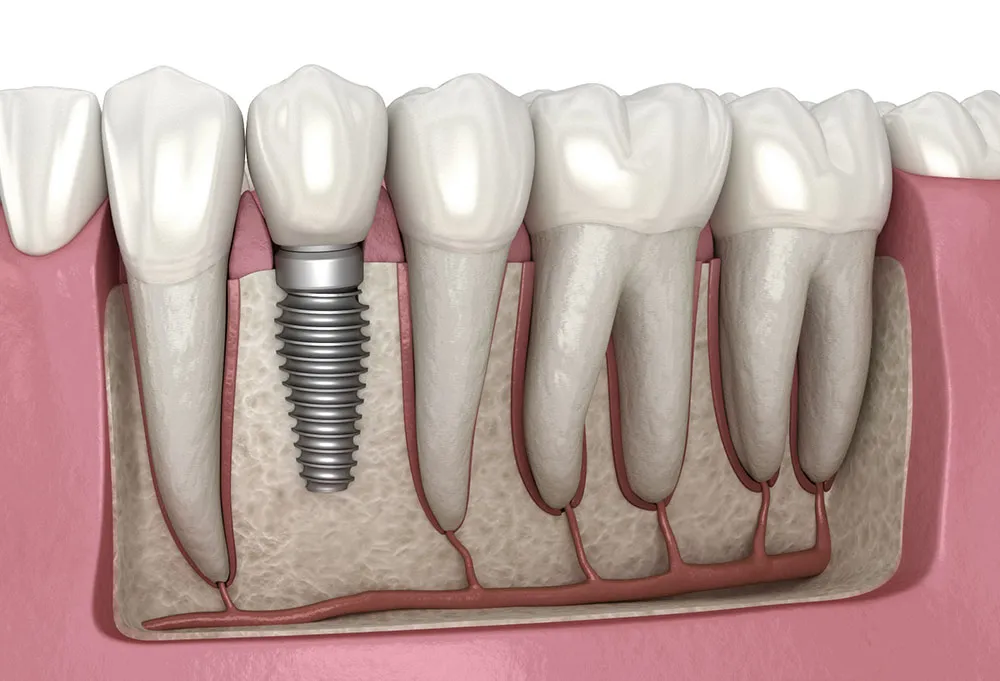 dental implants - Why No Dairy After Dental Implant
