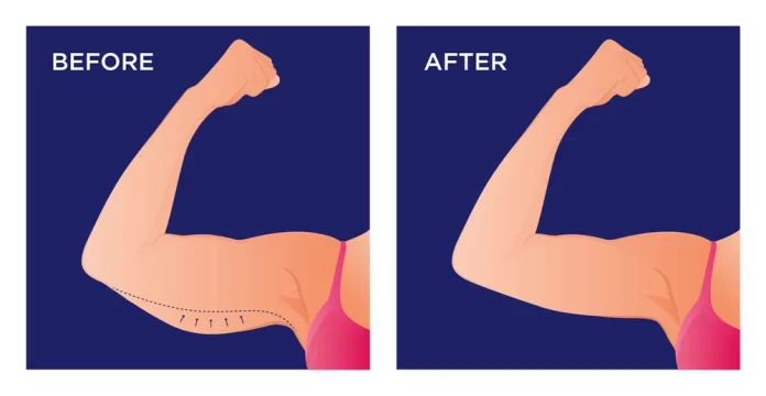 arm liposuction before after