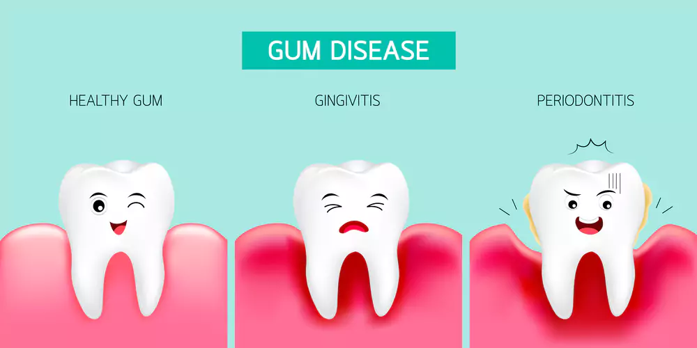 gum disease types