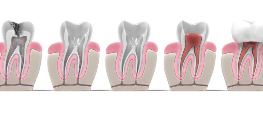 root canal and thorbbing pain