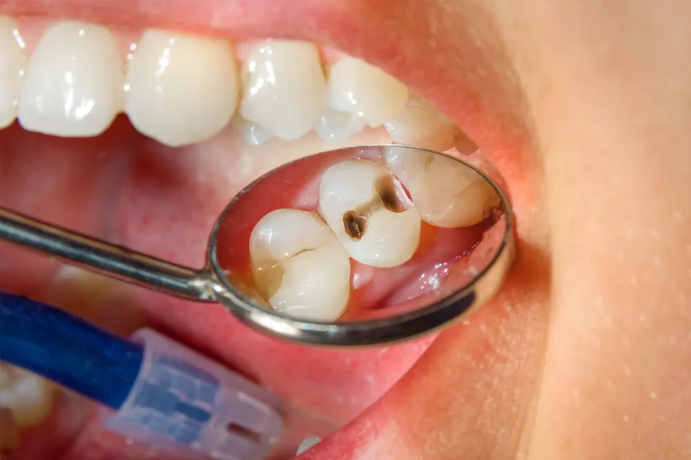 tooth cavity - can a cavity kill you