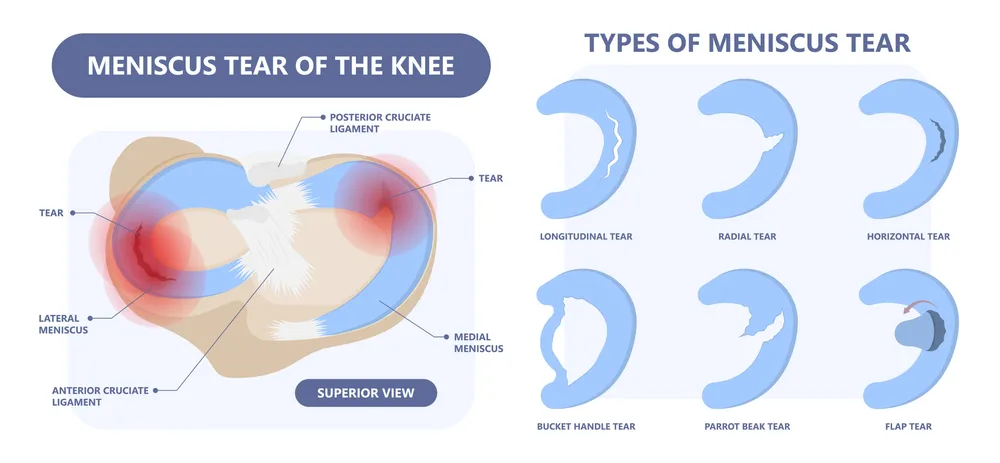 types of torn meniscus - can you run with a torn meniscus