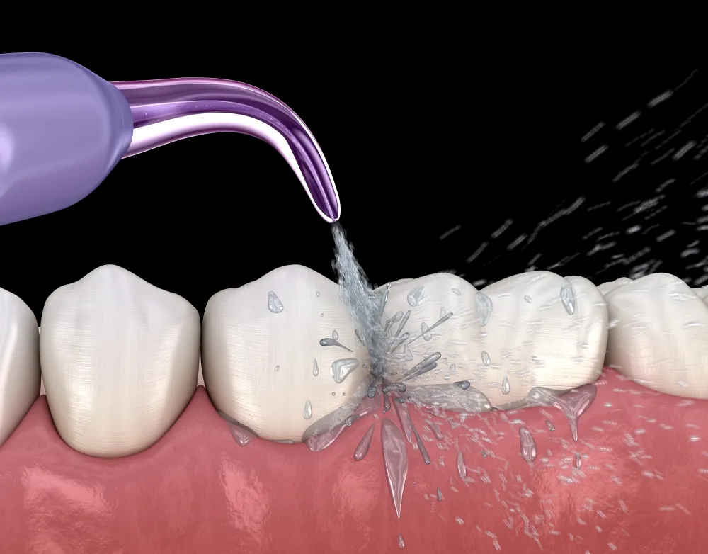 how to get food out of wisdom tooth hole- water flosser